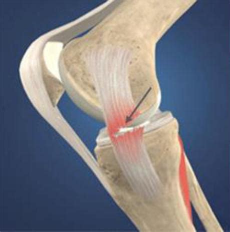 tear in ligaments